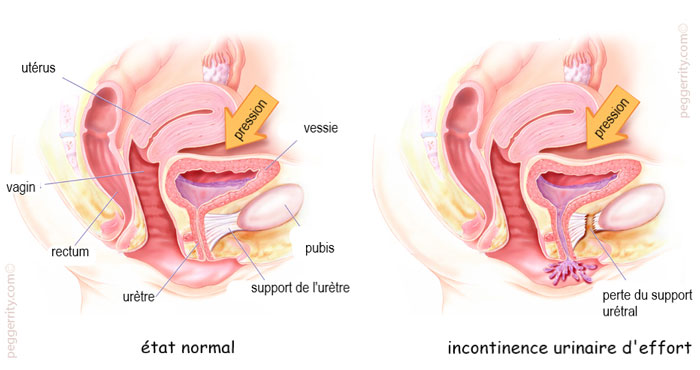 Incontinence urinaire féminine – Bandelettes – Centre Urologie Colmar