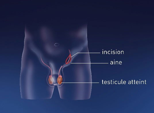 Cancer des testicules – Centre Urologie Colmar